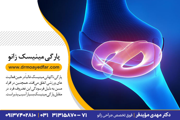 درمان پارگی مینیسک در اصفهان