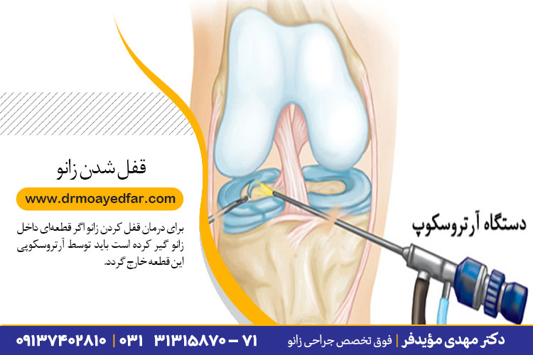 درمان قفل شدگی زانو در اصفهان