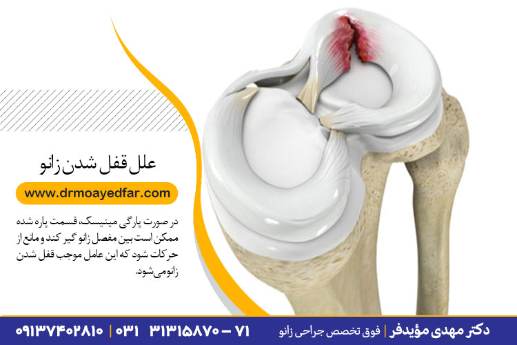 علل قفل شدن زانو در اصفهان