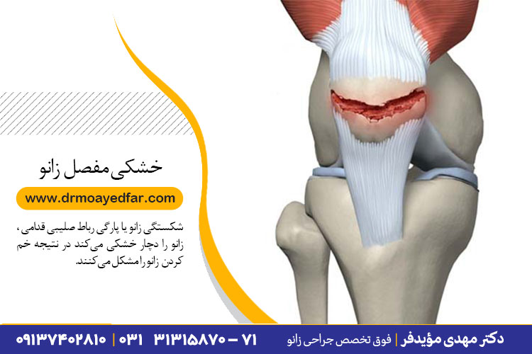 درمان خشکی مفصل زانو در اصفهان