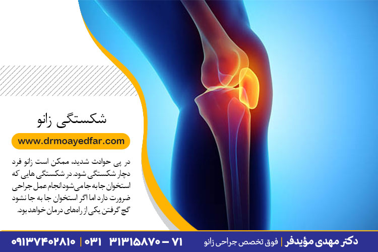 درمان شکستگی زانو در اصفهان