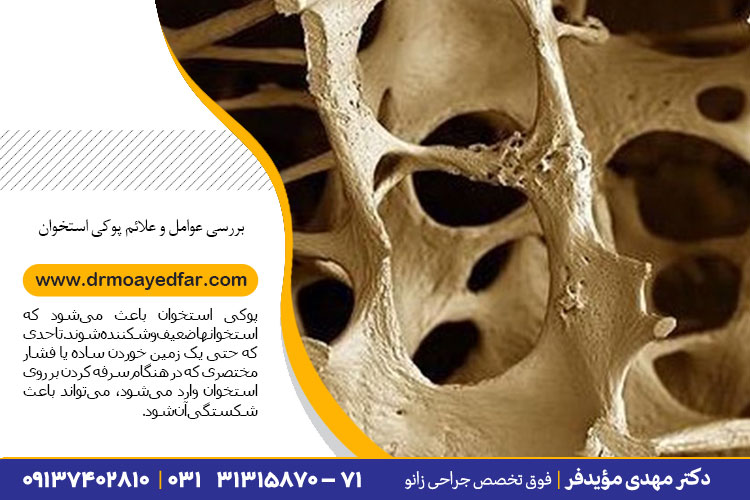 بررسی عوامل و علائم پوکی استخوان