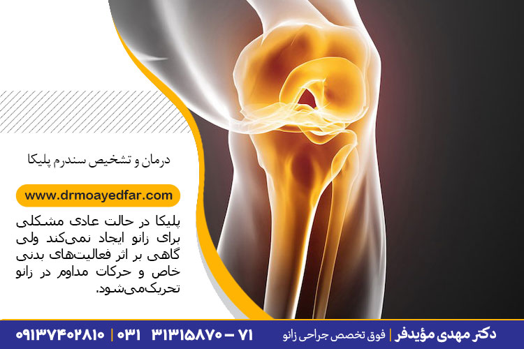 درمان و تشخیص سندرم پلیکا