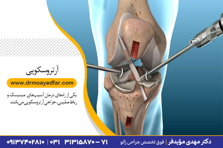 آرتروسکوپی در اصفهان