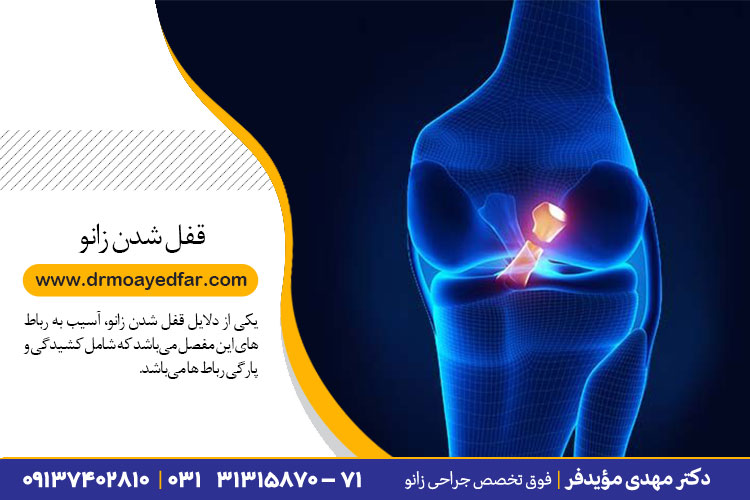 درمان قفل شدن زانو در اصفهان