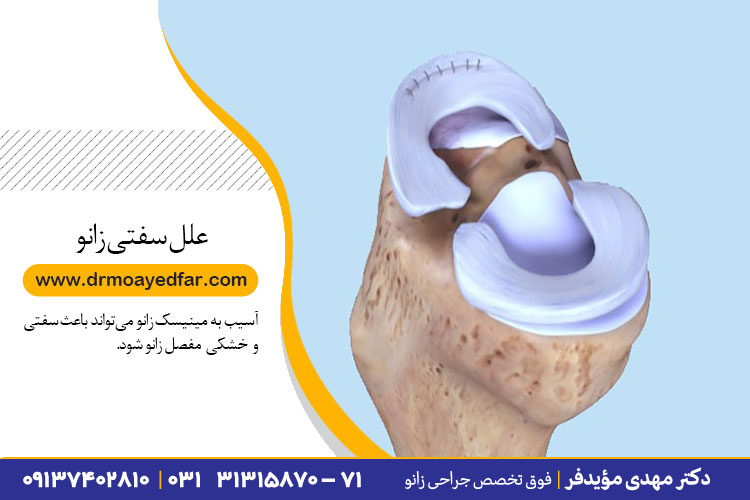 درمان سفتی زانو در اصفهان
