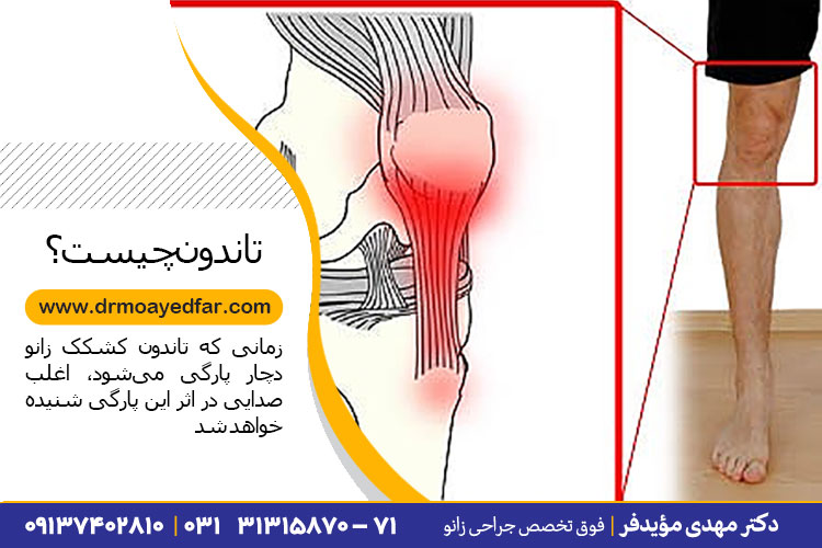 درمان پارگی تاندون در کلینیک دکتر مهدی مؤیدفر درمان پارگی تاندون در کلینیک دکتر مهدی مؤیدفر
