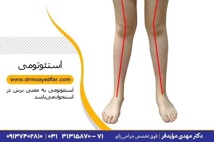 استئوتومی زانو در اصفهان