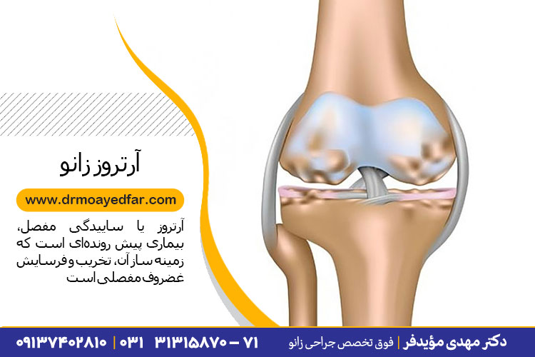 درمان آرتروز زانو در اصفهان