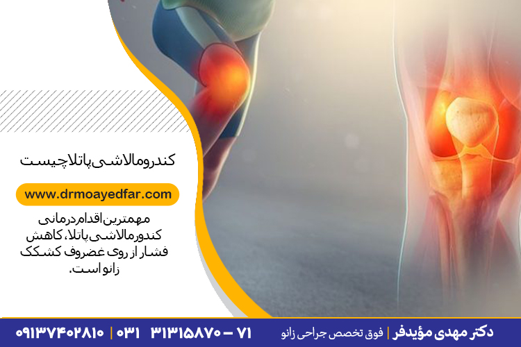 درمان نرمی غضروف کشکک زانو در اصفهان