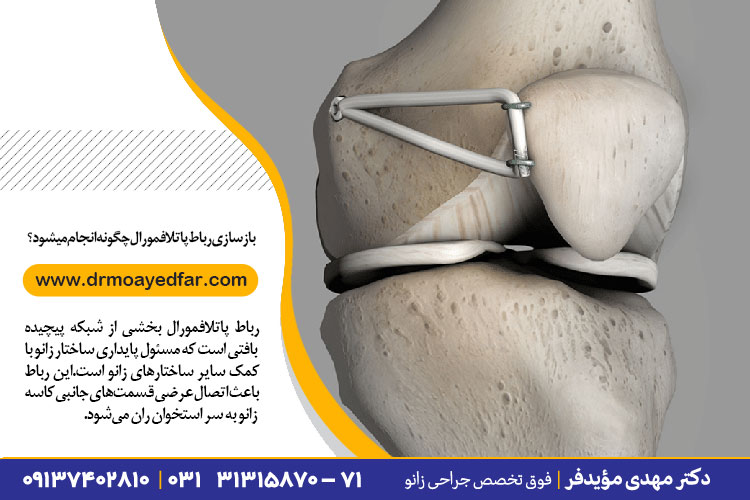 بازسازی رباط پاتلافمورال | آسیب رباط پاتلافمورال | دکتر مهدی مؤیدفر