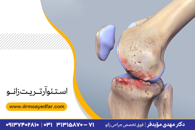 علائم استئوآرتريت زانو