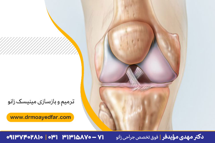 ترمیم و بازسازی مینیسک زانو