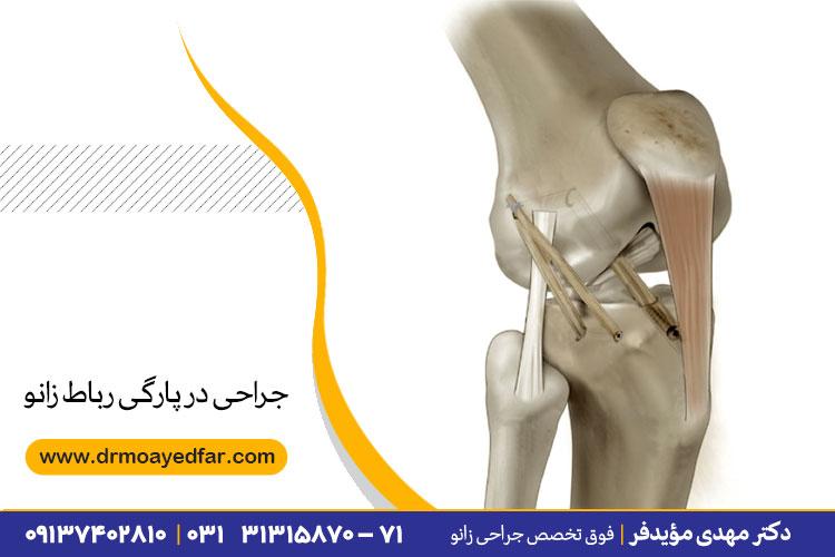 پارگی رباط زانو