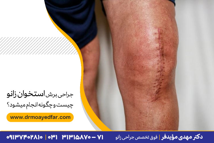 جراحی برش استخوان زانو چیست