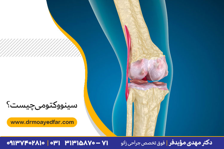 سینووکتومی چیست؟	