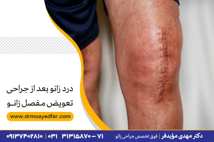 درد زانو بعد از جراحی تعویض مفصل زانو
