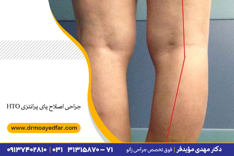 جراحی اصلاح پای پرانتزی