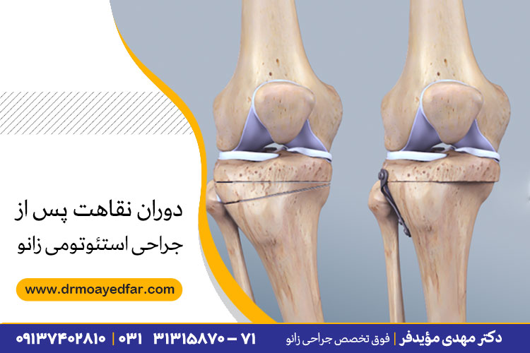 جراحی استئوتومی زانو