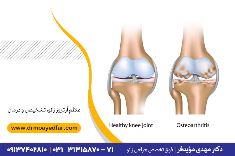 آرتروز