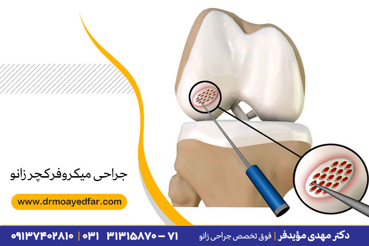 جراحی میکروفرکچر زانو