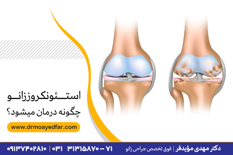 درمان استئونکروز زانو