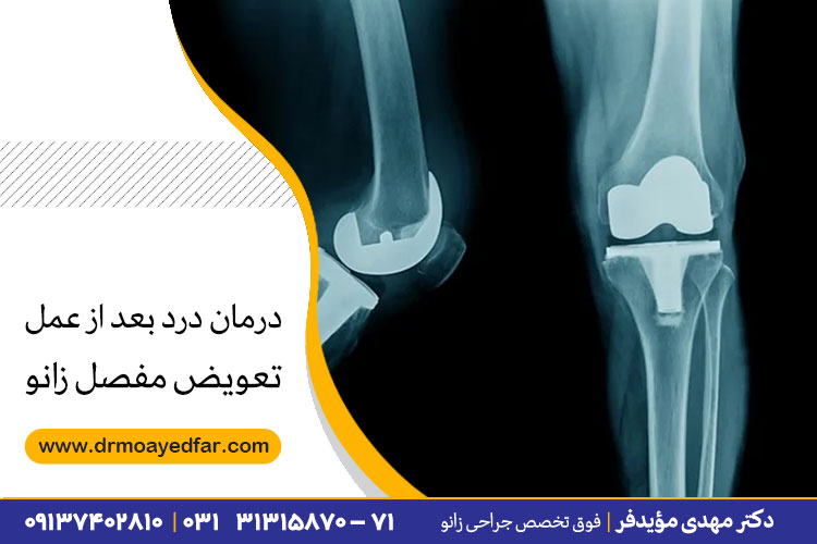 عمل تعویض مفصل زانو