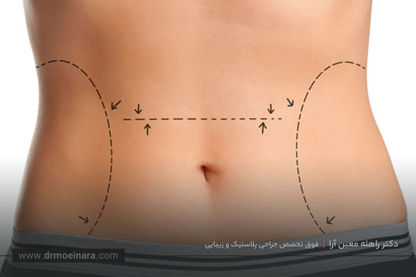 مراقبت های بعد از لیپوساکشن