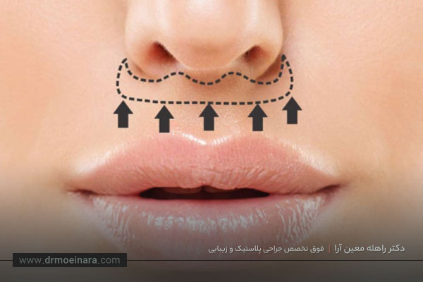 جراحی لیفت سانترال لب