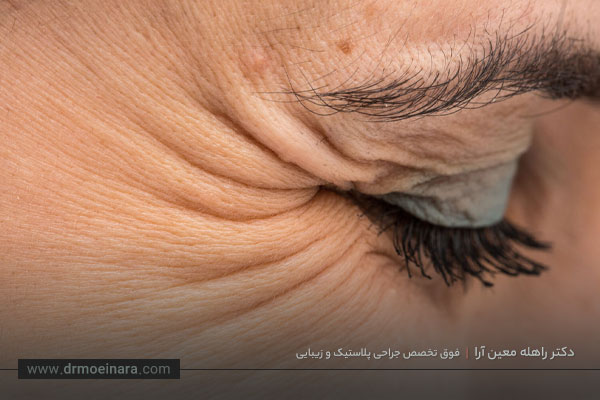 تزریق بوتاکس دور چشم