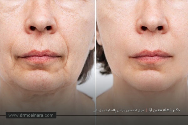 ماندگاری تزریق ژل