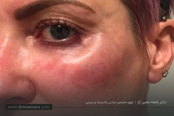 عوارض فیلر