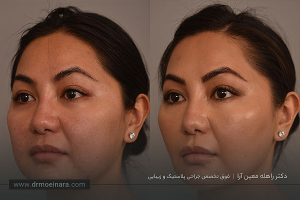 مراقبتهای بعد از بوکال فت