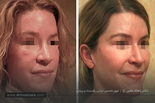 عوارض بوکال فت