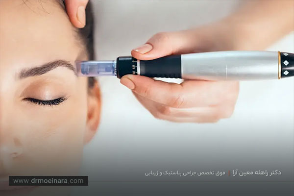 مزوتراپی در تهران