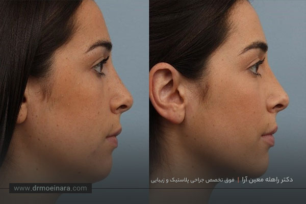 مزوتراپی غبغب