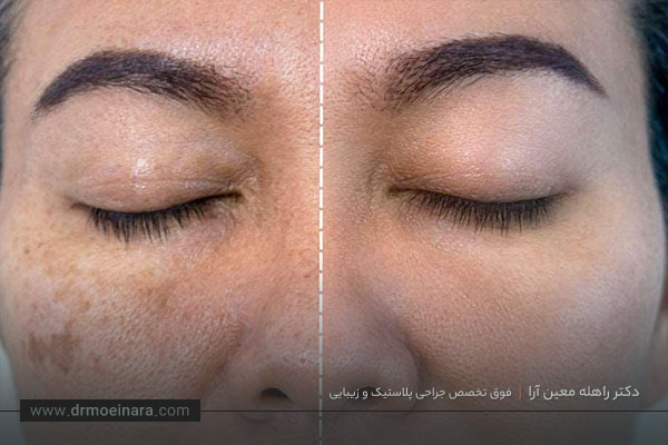 مراقبت بعد از مزوتراپی