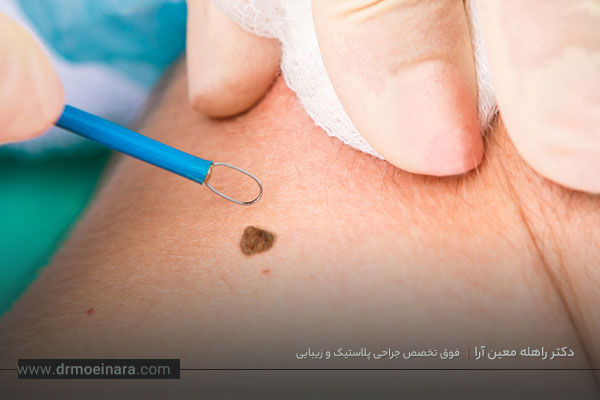 برداشتن ضایعات پوستی 