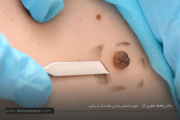 برداشتن خال 