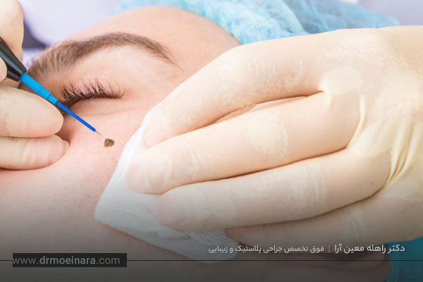 هزینه برداشتن خال 