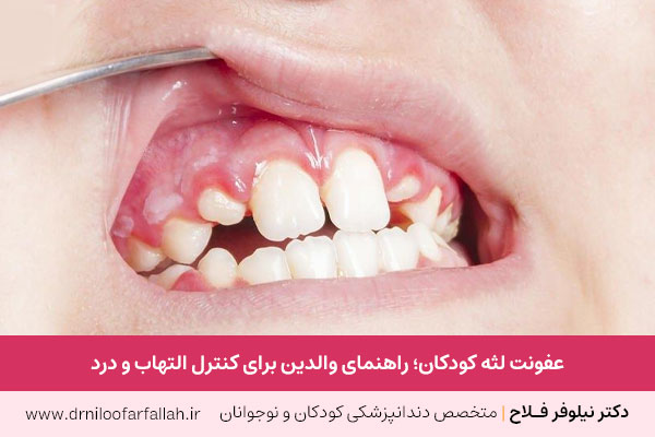 عفونت لثه کودکان