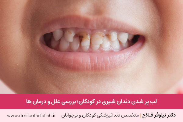علل لب پر شدن دندان شیری کودکان