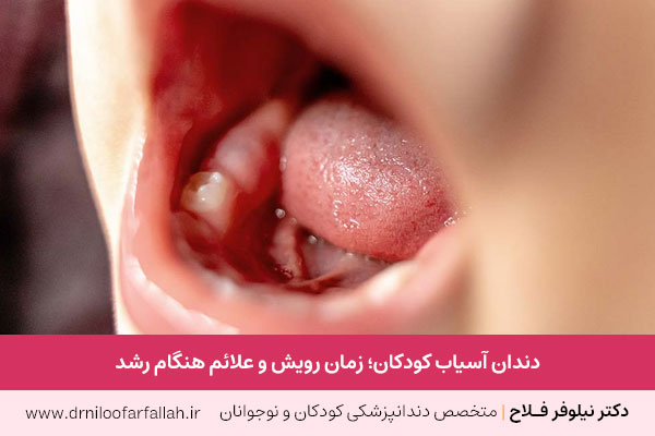دندان آسیاب شیری