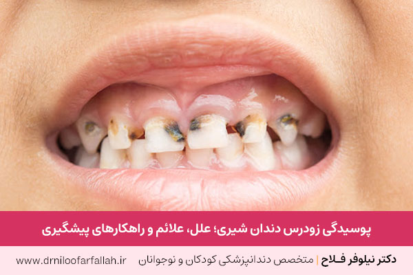 پوسیدگی زودرس دندان شیری