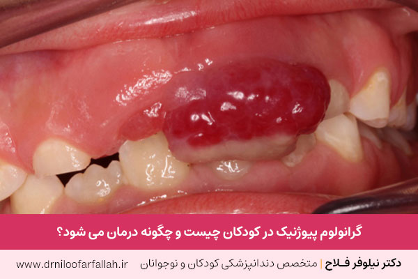 گرانولوم پیوژنیک در کودکان 