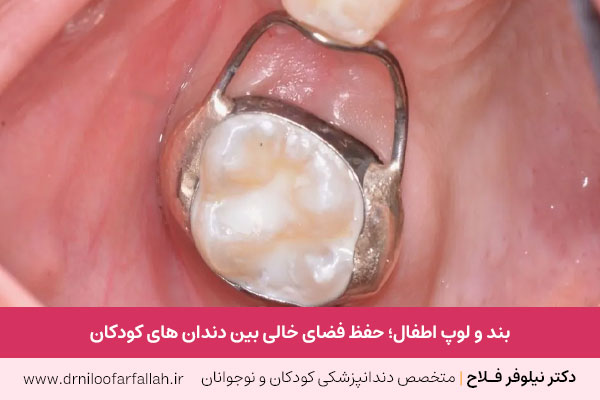 بند و لوپ دندان اطفال چیست