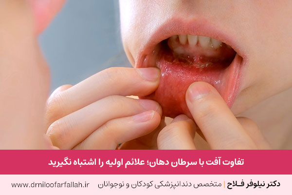 فرق آفت و سرطان دهان