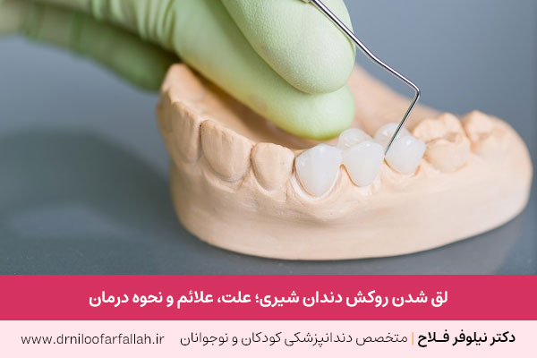 لق شدن روکش دندان شیری