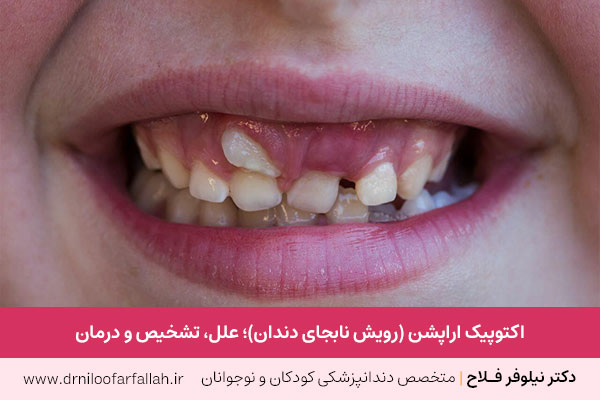 اکتوپیک اراپشن