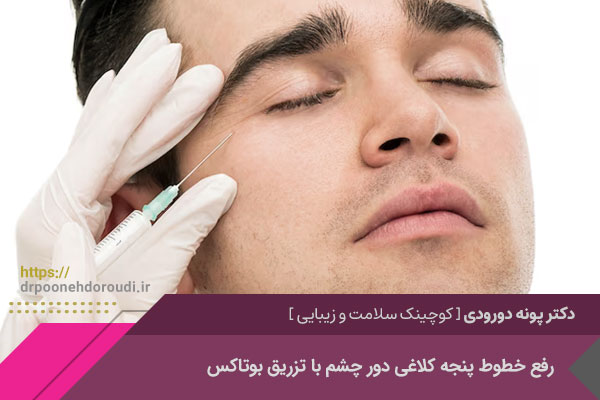 تزریق بوتاکس خطوط پنجه کلاغی دور چشم در اصفهان